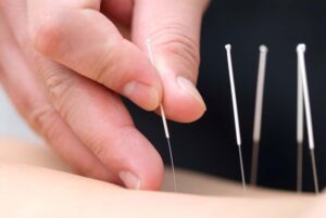Acupuncture for Lower Back Pain