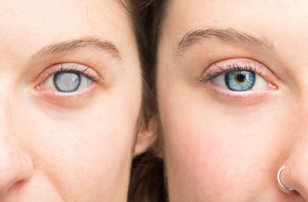 


laser eye surgery

